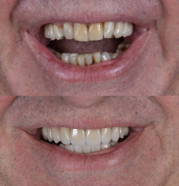 Antes e depois da reabilitação oral através de implante dentário