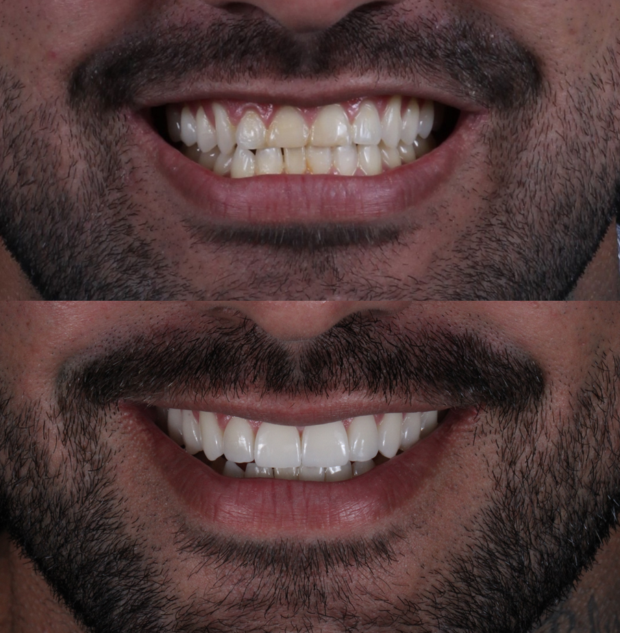 antes e depois de tratamento com lentes de contato dental