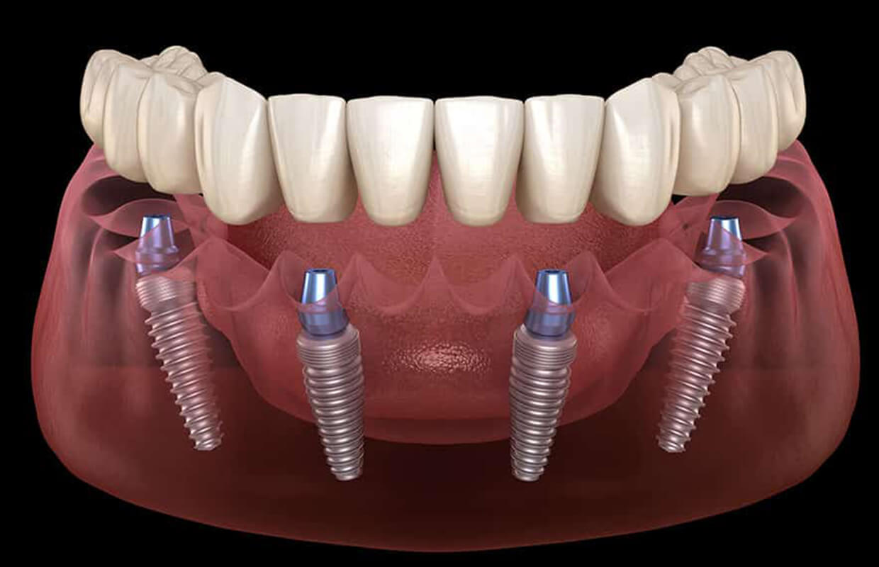 Prótese dentária fixa